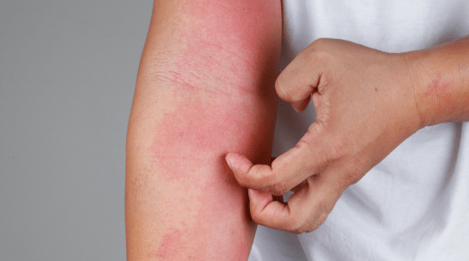 25 Effective Skin Allergy Medicines