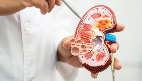 Kidney Stone Treatment: Effective Methods for Relief and Recovery