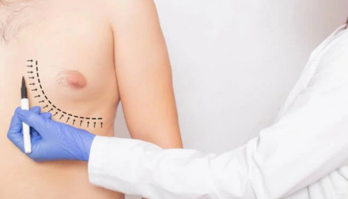 best gynecomastia surgeon in bangalore