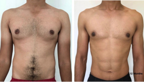 gynecomastia surgery in Bangalore